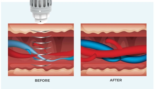 Portable EMS Vacuum Shockwave Therapy Emshock Pain Relief